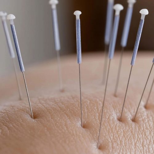 holistic-wellness-ancient-practice-acupuncture-delicate-placement-needles-human-body-emphasizing-balance-healing-therapeutic-benefits-this-traditional-method